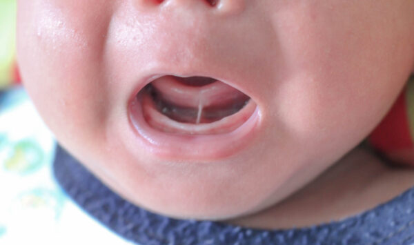 Baby: Verkürztes Zungenband